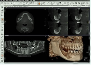 dental tomografi